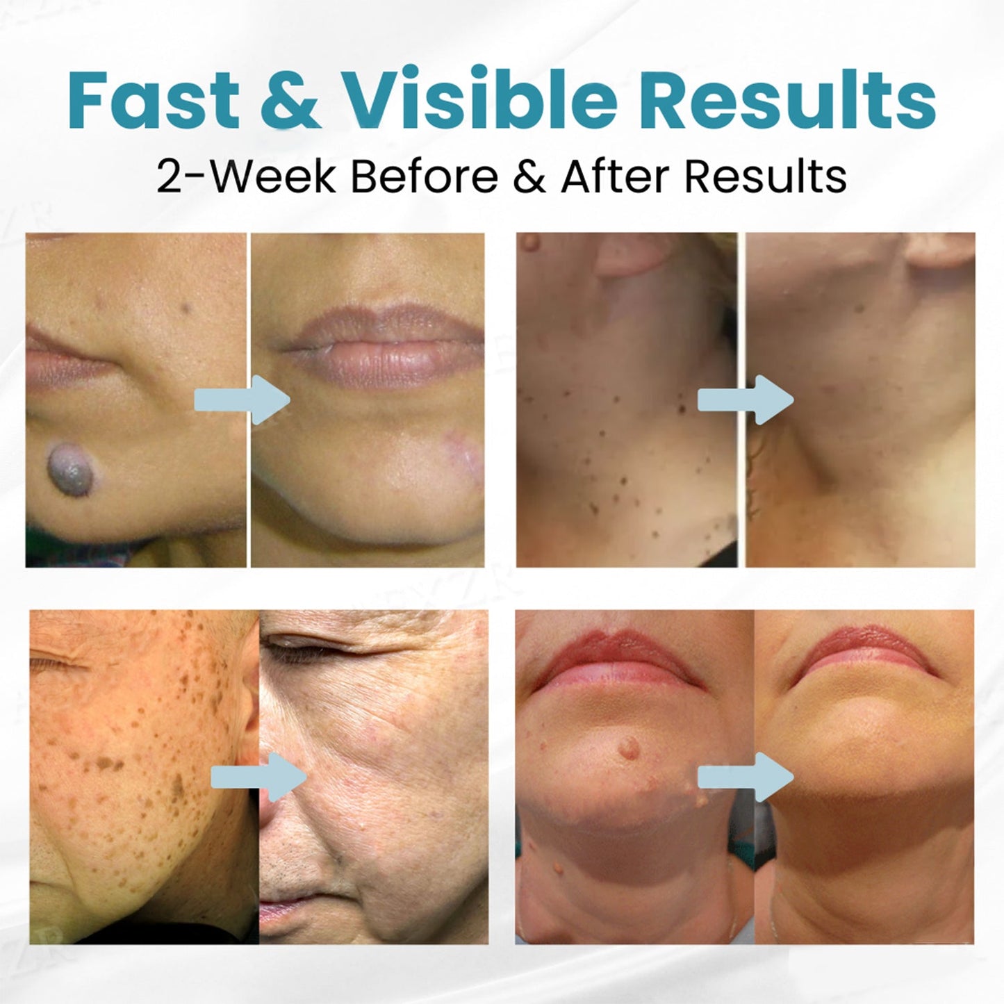 AQA™ Non-Invasive Mole and Wart Removal Laser Pen